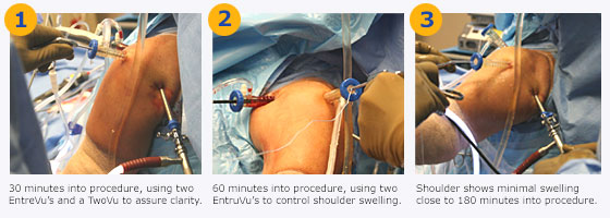 EntreVu Visibly Reduces Interstitial Swelling